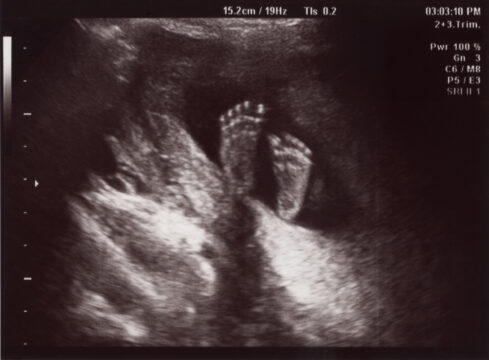 Ultrasound of In Uterus Baby at 22 weeks.